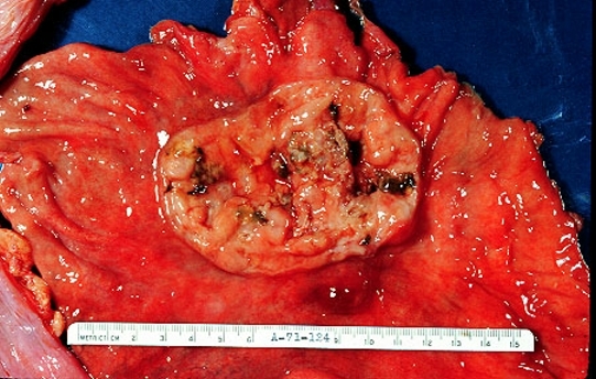 imagini cancerul stomacului